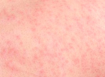 Itchy Red Bumps on Skin